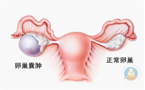 女性最不容忽视的器官--卵巢