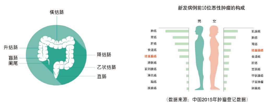 肠癌风险早知道，防患未然助健康