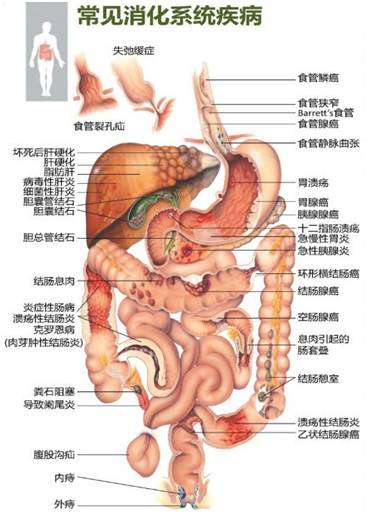诊治消化道疾病的福音--PillCam消化道胶囊内镜